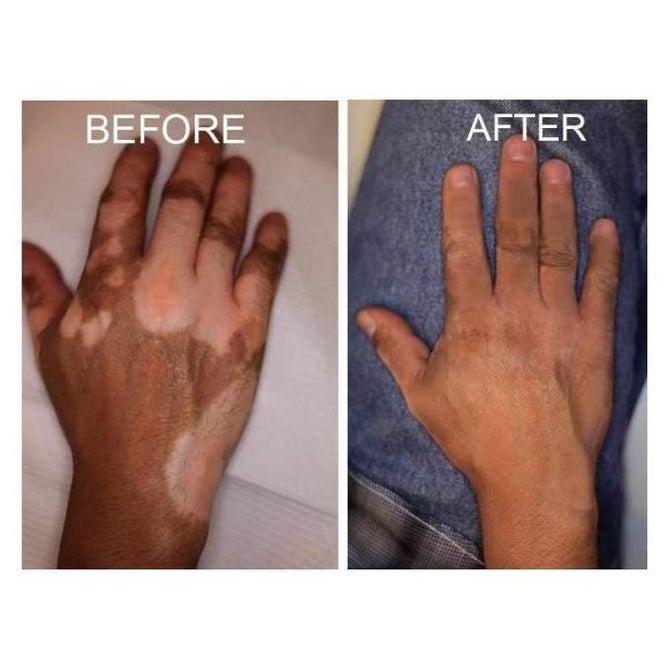 Clovate 0.5mg/g Crema كلوفات كريمة للبرص